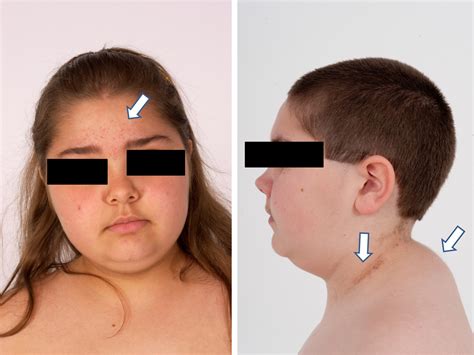 cushing's syndrome in children